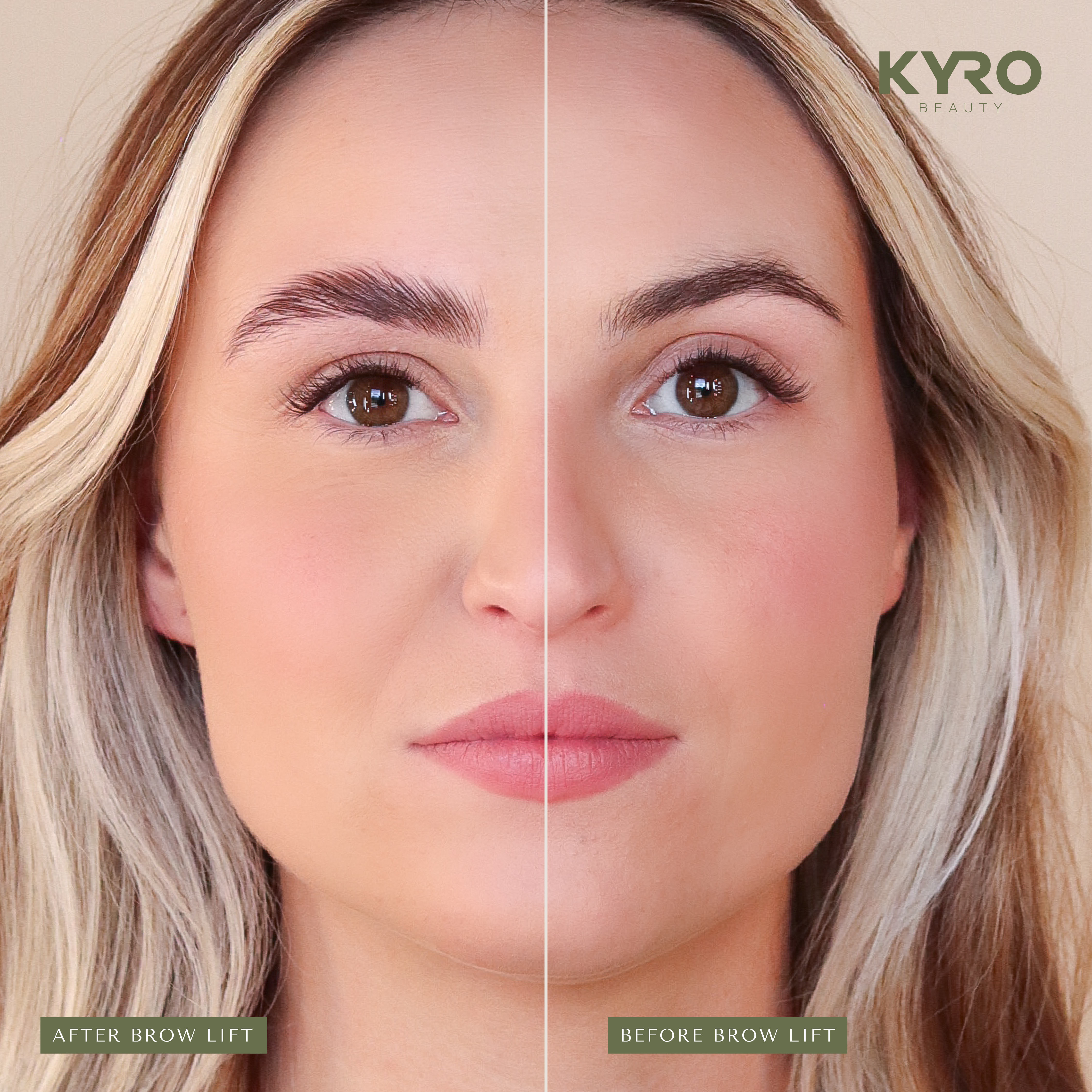 Brow Lift Results
